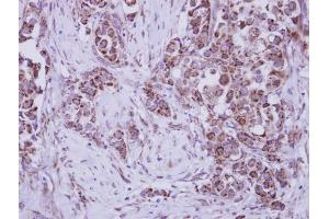 IHC-P Image Immunohistochemical analysis of paraffin-embedded human breast cancer, using MUSK, antibody at 1:250 dilution. (MUSK antibody  (N-Term))