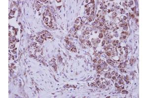 IHC-P Image Immunohistochemical analysis of paraffin-embedded human breast cancer, using MUSK, antibody at 1:250 dilution.