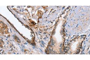 Immunohistochemistry of paraffin-embedded Human prostate cancer using MAD2L1BP Polyclonal Antibody at dilution of 1:65 (MAD2L1BP antibody)