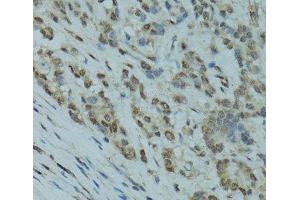 Immunohistochemistry of paraffin-embedded Human colon carcinoma using GABPA Polyclonal Antibody at dilution of 1:100 (40x lens). (GABPA antibody)