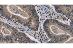 Immunohistochemistry of paraffin-embedded Human colon cancer using MCM3AP Polyclonal Antibody at dilution of 1:30 (GANP antibody)