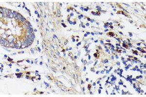 Immunohistochemistry of paraffin-embedded Human colon carcinoma using TREM2 Polyclonal Antibody at dilution of 1:200 (40x lens). (TREM2 antibody)