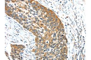 The image on the left is immunohistochemistry of paraffin-embedded Human esophagus cancer tissue using ABIN7131474(TRIM16 Antibody) at dilution 1/35, on the right is treated with fusion protein.
