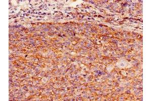 Immunohistochemistry of paraffin-embedded human pancreatic cancer using ABIN7154773 at dilution of 1:100 (GBP2 antibody  (AA 100-259))
