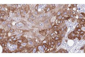 ABIN6274028 at 1/100 staining Human Head and neck cancer tissue by IHC-P. (PD-1 antibody  (Internal Region))