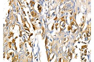 ABIN6264786 and ABIN6278631 at 1/100 staining Human esophageal cancer by IHC-P.