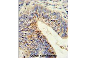 Formalin-fixed and paraffin-embedded human colon carcinoma reacted with ADAMDEC1 Antibody (N-term), which was peroxidase-conjugated to the secondary antibody, followed by DAB staining. (ADAMDEC1 antibody  (N-Term))