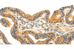 Immunohistochemistry of paraffin-embedded Human thyroid cancer tissue using RRAGA Polyclonal Antibody at dilution 1:30