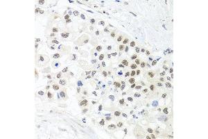 Immunohistochemistry of paraffin-embedded human lung cancer using TRMT1 antibody at dilution of 1:100 (x40 lens). (TRMT1 antibody)