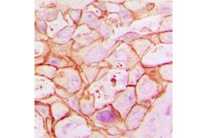 Immunohistochemical analysis of ARALAR1 staining in human breast cancer formalin fixed paraffin embedded tissue section. (SLC25A12 antibody  (Center))