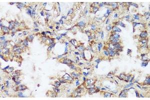 Immunohistochemistry of paraffin-embedded Human lung cancer using ERK1 / ERK2 Polyclonal Antibody at dilution of 1:200 (40x lens). (ERK1/2 antibody)