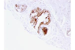 Formalin-fixed, paraffin-embedded human Prostate Carcinoma stained with p57 Mouse Monoclonal Antibody (57P06). (CDKN1C antibody)