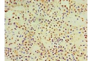 Immunohistochemistry of paraffin-embedded human breast cancer using ABIN7149492 at dilution of 1:100 (DACT3 antibody  (AA 1-160))
