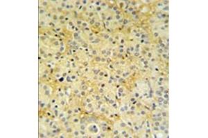 Formalin fixed, paraffin embedded prostate carcinoma stained with DAZAP2 Antibody (C-term) followed by peroxidase conjugation of the secondary antibody and DAB staining. (DAZAP2 antibody  (C-Term))
