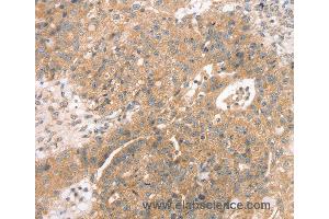 Immunohistochemistry of Human breast cancer using STX10 Polyclonal Antibody at dilution of 1:45