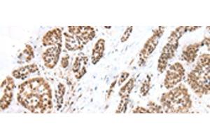 Immunohistochemistry of paraffin-embedded Human esophagus cancer tissue using FOXG1 Polyclonal Antibody at dilution of 1:60(x200) (FOXG1 antibody)