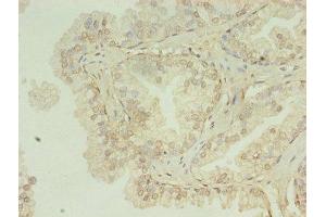 Immunohistochemistry of paraffin-embedded human prostate cancer using ABIN7155120 at dilution of 1:100 (HNRNPL antibody  (AA 89-335))
