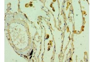 Immunohistochemistry of paraffin-embedded human lung cancer using ABIN7171841 at dilution of 1:100 (CLEC3B antibody  (AA 22-202))