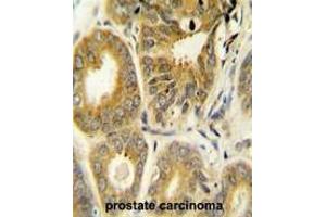 ARL8A Antibody (Center) immunohistochemistry analysis in formalin fixed and paraffin embedded human prostate carcinoma followed by peroxidase conjugation of the secondary antibody and DAB staining. (ARL8A antibody  (Middle Region))