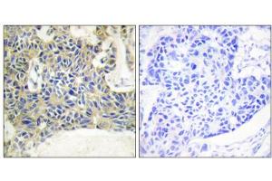Immunohistochemistry analysis of paraffin-embedded human breast carcinoma tissue using PKC theta (Phospho-Ser695) antibody. (PKC theta antibody  (pSer695))