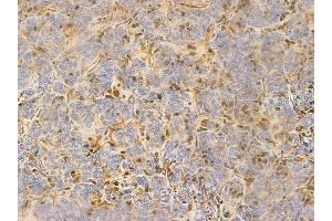 ABIN6261428 and ABIN6266649 at 1/100 staining human thymoma by IHC-P.