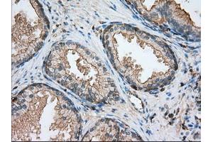 Immunohistochemical staining of paraffin-embedded Adenocarcinoma of ovary tissue using anti-ALDH3A1 mouse monoclonal antibody. (ALDH3A1 antibody)