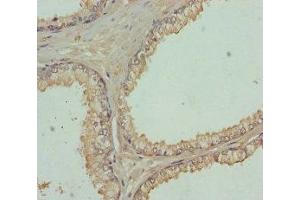Immunohistochemistry of paraffin-embedded human prostate cancer using ABIN7152450 at dilution of 1:100 (FBXO7 antibody  (AA 353-522))