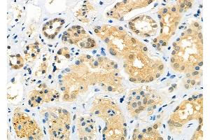 ABIN6260357 and ABIN6273203 at 1/100 staining Human kidney cancer and adjacent normal tissues by IHC-P. (C14orf166 antibody  (N-Term))