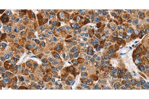 Immunohistochemistry of paraffin-embedded Human liver cancer tissue using SLAMF8 Polyclonal Antibody at dilution 1:40 (SLAMF8 antibody)
