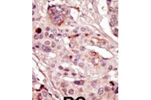 Formalin-fixed and paraffin-embedded human cancer tissue reacted with the primary antibody, which was peroxidase-conjugated to the secondary antibody, followed by AEC staining. (SRMS antibody  (N-Term))