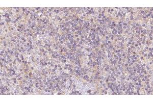 ABIN6273103 at 1/100 staining Human lymph cancer tissue by IHC-P. (Coq7 antibody  (Internal Region))