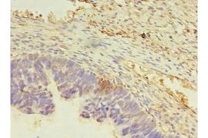 Immunohistochemistry of paraffin-embedded human ovarian cancer using ABIN7165486 at dilution of 1:100 (FAM32A antibody  (AA 1-112))