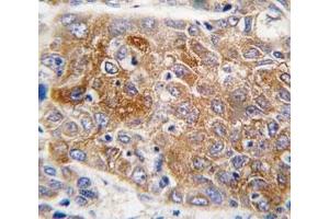 IHC analysis of FFPE human hepatocarcinoma tissue stained with ALDH1L1 antibody (ALDH1L1 antibody  (AA 717-746))