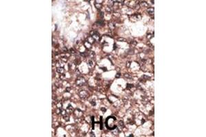 Formalin-fixed and paraffin-embedded human cancer tissue reacted with the primary antibody, which was peroxidase-conjugated to the secondary antibody, followed by DAB staining. (LRP8 antibody  (C-Term))