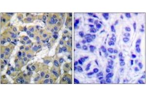 Immunohistochemistry analysis of paraffin-embedded human breast carcinoma, using Keratin 8 (Phospho-Ser73) Antibody. (KRT8 antibody  (pSer73))