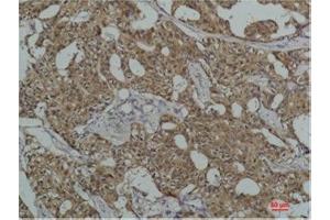 Immunohistochemistry (IHC) analysis of paraffin-embedded Human Breast Carcicnoma using HSC70 Mouse Monoclonal Antibody diluted at 1:200.