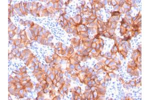 Formalin-fixed, paraffin-embedded human Breast Carcinoma stained with HER-2 Mouse Monoclonal Antibody (ERBB2/3079). (ErbB2/Her2 antibody  (AA 311-462))