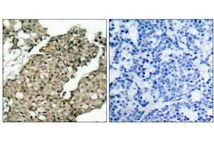 Immunohistochemical analysis of paraffin-embedded human breast carcinoma tissue using G3BP-1 (phospho-Ser232) antibody (E021102). (G3BP1 antibody  (pSer232))