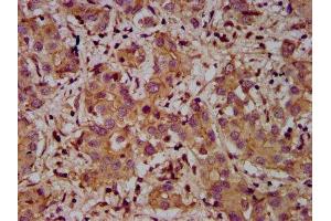 IHC image of ABIN7150047 diluted at 1:400 and staining in paraffin-embedded human liver cancer performed on a Leica BondTM system. (Adam23 antibody  (AA 498-647))