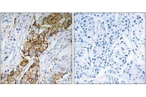 Immunohistochemistry analysis of paraffin-embedded human breast carcinoma tissue, using USP32 Antibody. (USP32 antibody  (AA 271-320))