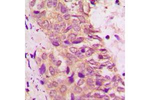 Immunohistochemical analysis of BAD staining in human prostate cancer formalin fixed paraffin embedded tissue section. (BAD antibody  (C-Term))