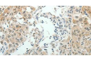 Immunohistochemistry of paraffin-embedded Human lung cancer using NDRG2 Polyclonal Antibody at dilution of 1:50 (NDRG2 antibody)