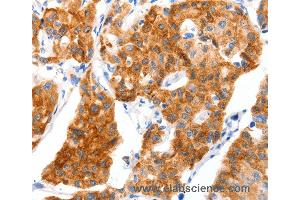 Immunohistochemistry of Human colon cancer using SLC2A4 Polyclonal Antibody at dilution of 1:70 (GLUT4 antibody)