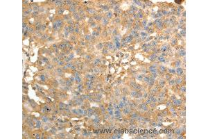 Immunohistochemistry of Human ovarian cancer using PSMD9 Polyclonal Antibody at dilution of 1:40