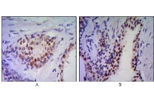 Immunohistochemical analysis of paraffin-embedded human prostata tissues (A, B) using anti-NKX3A antibody with DAB staining. (NKX3-1 antibody)