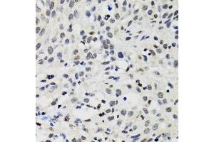 Immunohistochemistry of paraffin-embedded human lung cancer using SMARCAD1 antibody (ABIN2560015) at dilution of 1:100 (40x lens).