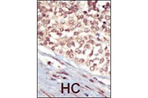 Formalin-fixed and paraffin-embedded human cancer tissue reacted with the primary antibody, which was peroxidase-conjugated to the secondary antibody, followed by AEC staining. (EPH Receptor A5 antibody  (C-Term))