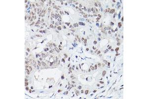Immunohistochemistry of paraffin-embedded human colon carcinoma using DNA Ligase IV Rabbit pAb (ABIN3022474, ABIN3022475, ABIN3022476 and ABIN6218843) at dilution of 1:100 (40x lens). (LIG4 antibody  (AA 612-911))