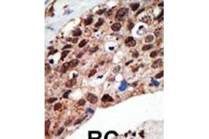Formalin-fixed and paraffin-embedded human cancer tissue reacted with the primary antibody, which was peroxidase-conjugated to the secondary antibody, followed by DAB staining. (SET7 antibody  (AA 159-189))