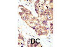 Formalin-fixed and paraffin-embedded human cancer tissue reacted with DOK5 polyclonal antibody  , which was peroxidase-conjugated to the secondary antibody, followed by AEC staining. (DOK5 antibody  (AA 276-306))